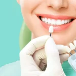 Lentes de Contato Dental em Fortaleza